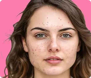 Pakiet Trądzik hormonalny dla kobiet