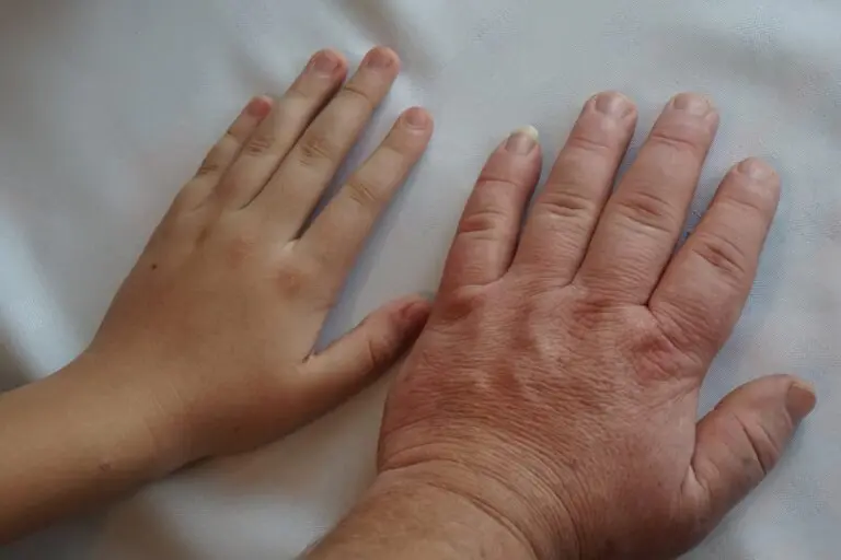 Akromegalia – co to za choroba i jakie są jej przyczyny? Objawy, diagnostyka i leczenie