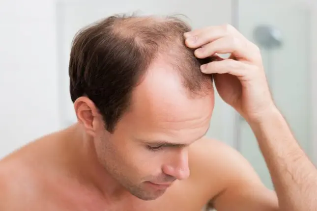 Łysienie telogenowe – objawy, przyczyny, skutki