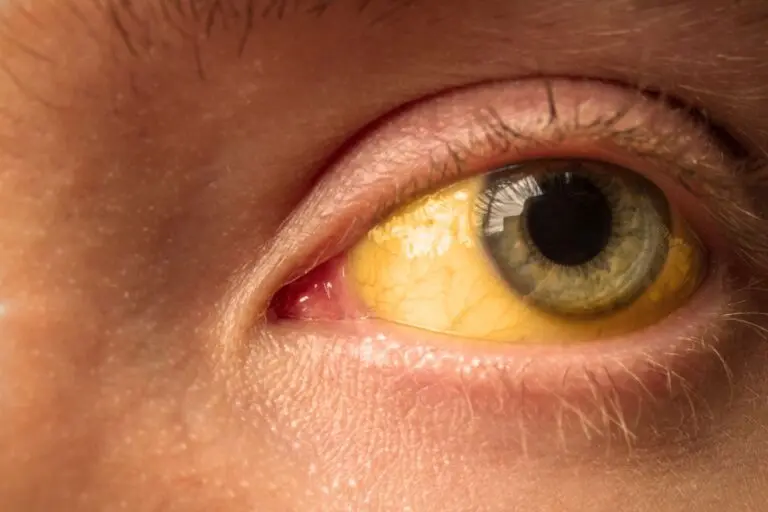 Żółte oczy, jakie mogą być przyczyny? Czego objawem są żółte białka oczu?  