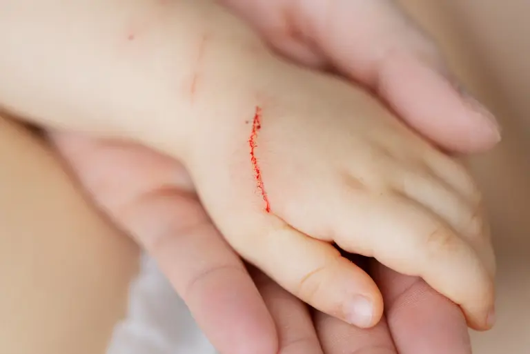 Choroba kociego pazura objawy, przyczyny, diagnostyka i leczenie