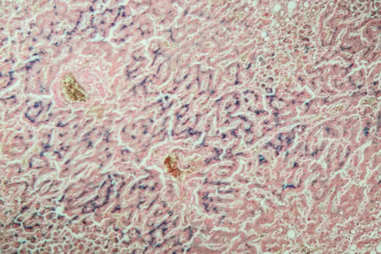Co warto wiedzieć o hemosyderozie?