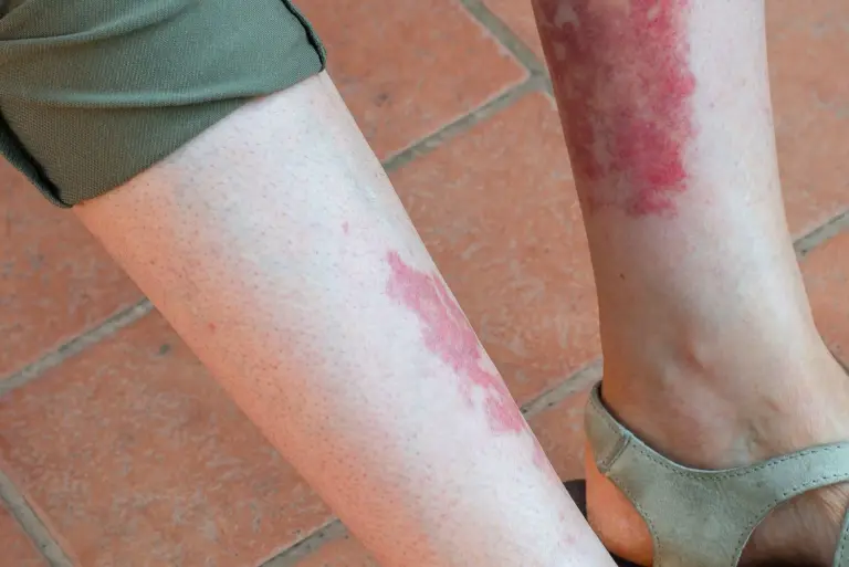 Zapalenia małych naczyń (vasculitis) – diagnostyka