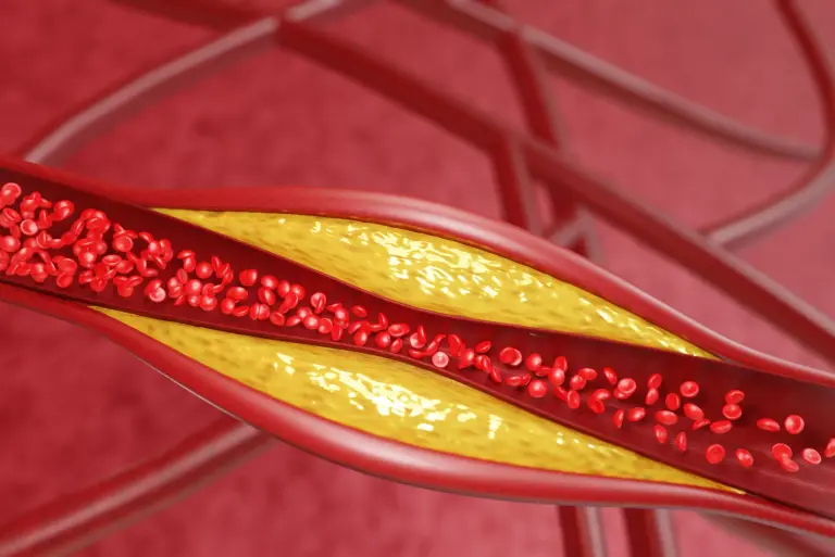 Cholesterol LDL – co to jest? Przyczyny podwyższonego cholesterolu, badania i redukcja