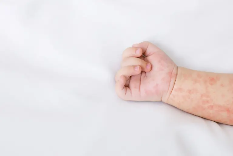 Wysypka u dzieci – możliwe przyczyny, diagnostyka i leczenie