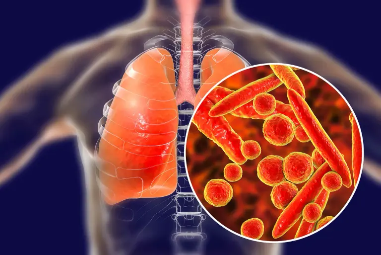 Mykoplazma u dzieci i dorosłych – objawy, diagnostyka, leczenie