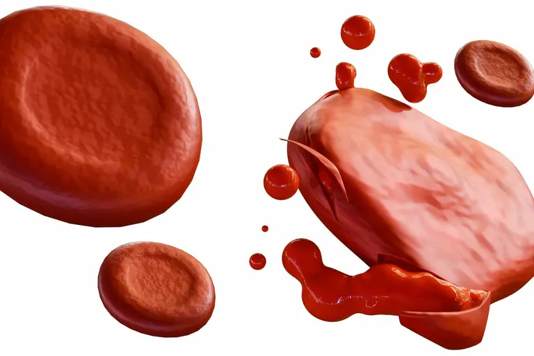 Hemoliza – co to jest? Objawy, przyczyny, diagnostyka i leczenie