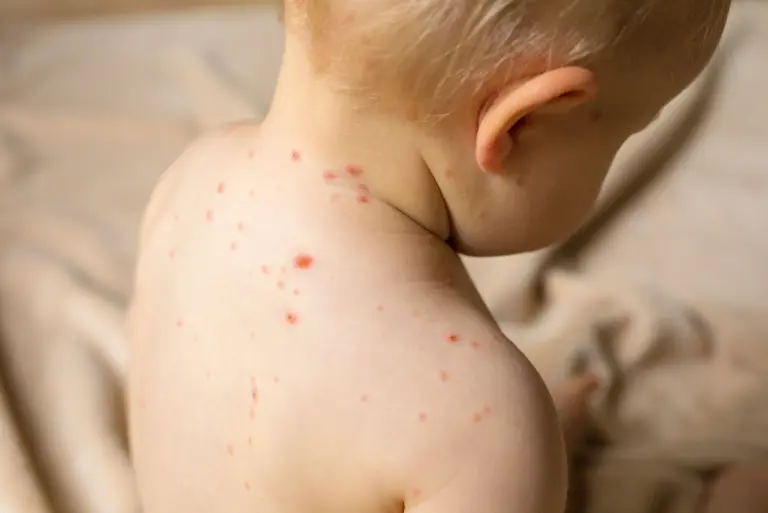 Ospa wietrzna u dzieci. Objawy, diagnostyka i leczenie