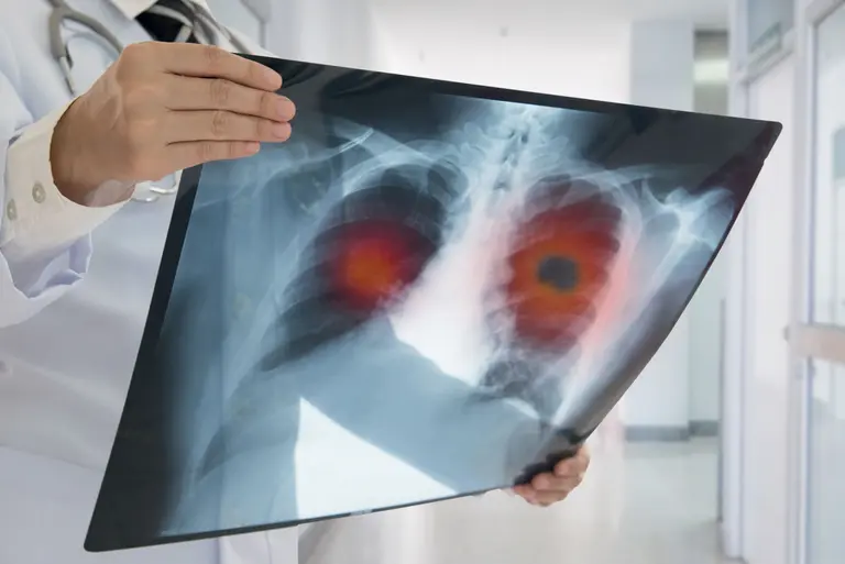 Rak płuc – objawy, diagnostyka i leczenie nowotworu     