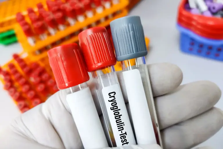 Krioglobulinemia - objawy, diagnostyka i leczenie