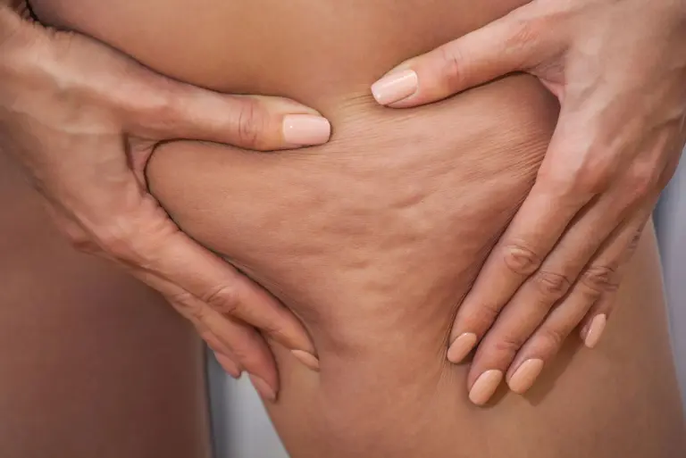 Lipodystrofia - co to jest? Objawy, rodzaje, przyczyny, badania i leczenie lipoatrofii