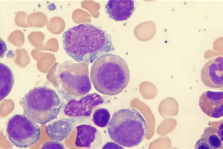 Zespoły mielodysplastyczne – objawy, diagnostyka i leczenie