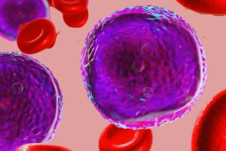 Białaczka limfoblastyczna – przyczyny, objawy, diagnostyka