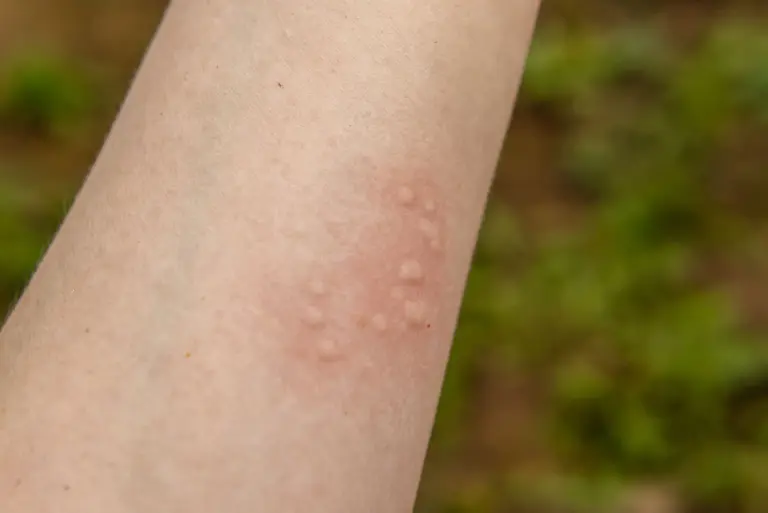 Pokrzywka alergiczna: objawy, przyczyny, leczenie