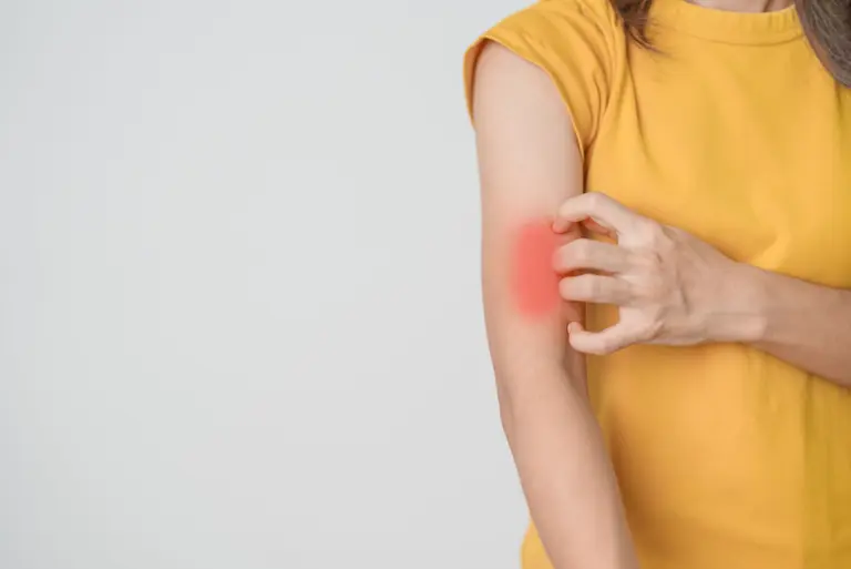 Rumień alergiczny: jak wygląda? Objawy, przyczyny, ile trwa