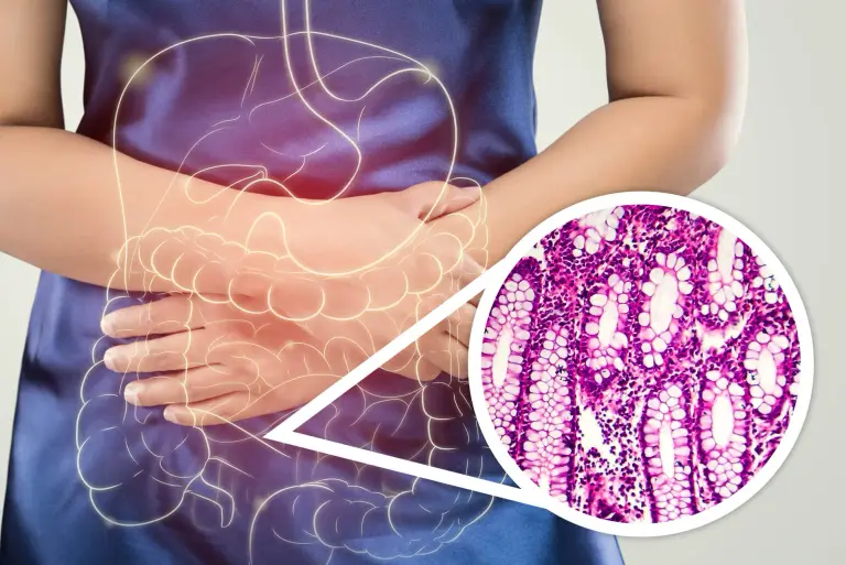 Czerwonka (dyzenteria) – co to za choroba? Objawy i leczenie 