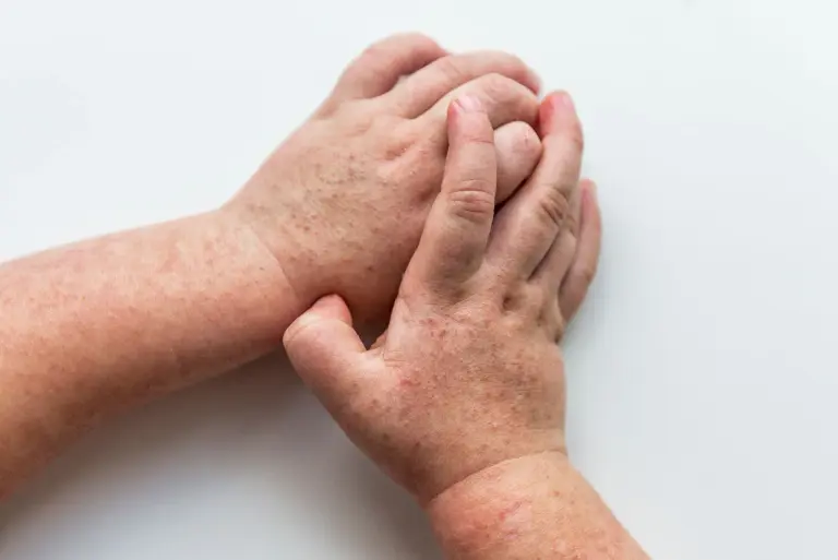 Szkarlatyna (płonica) u dzieci i dorosłych: objawy, przyczyny, diagnostyka i leczenie