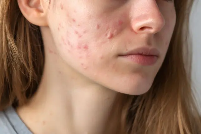Trądzik hormonalny, jak go rozpoznać i leczyć? Przyczyny i objawy