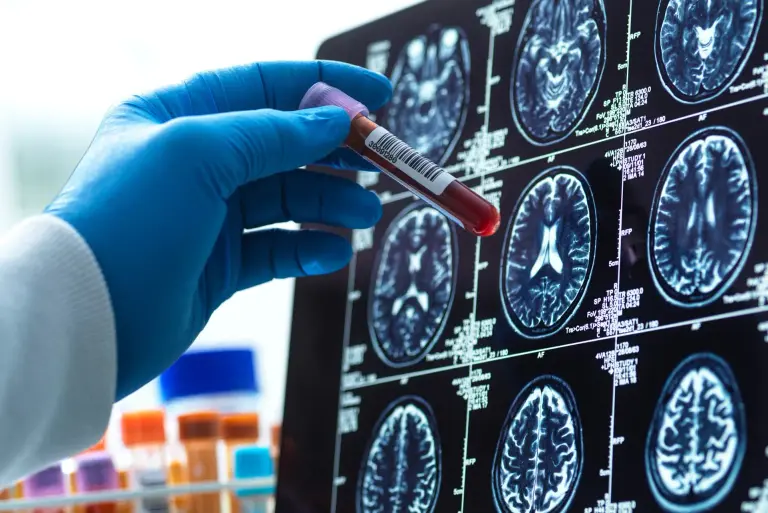 Badanie p-tau217 - czy zmiany związane z chorobą Alzheimera można wykryć przed objawami?