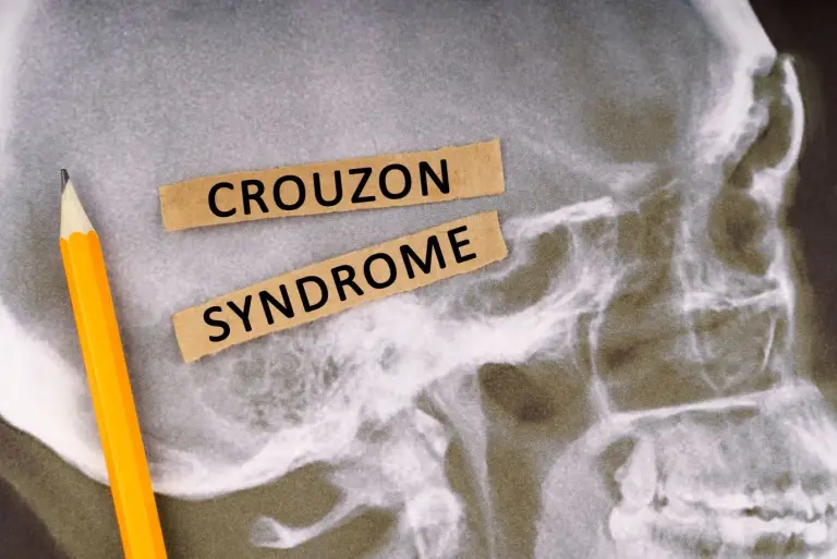 Zespół (choroba) Crouzona – objawy, leczenie, rokowania