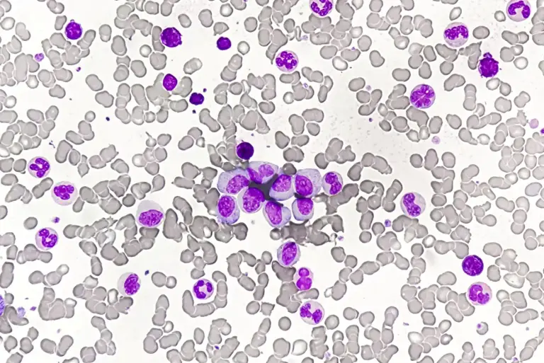 Przewlekła białaczka szpikowa – objawy, diagnostyka, leczenie, rokowania