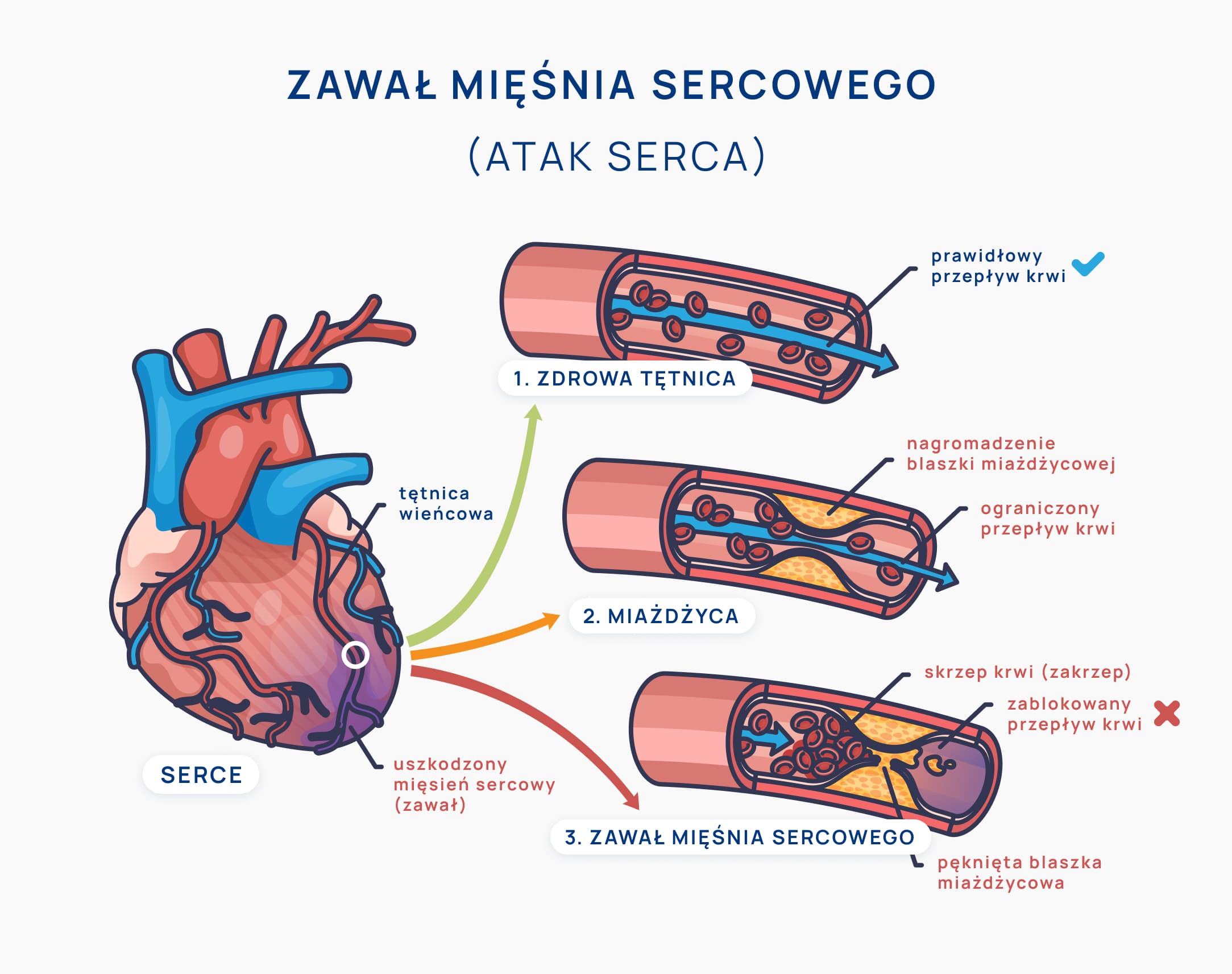 zawał serca infografika