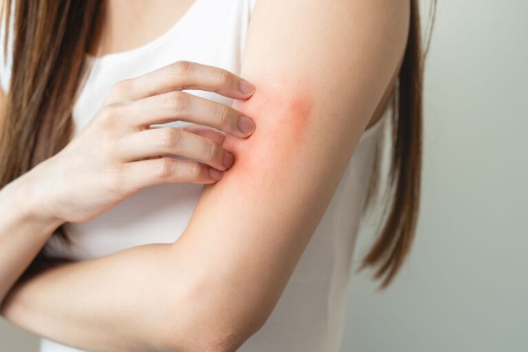 Wysypka alergiczna: przyczyny, objawy, leczenie