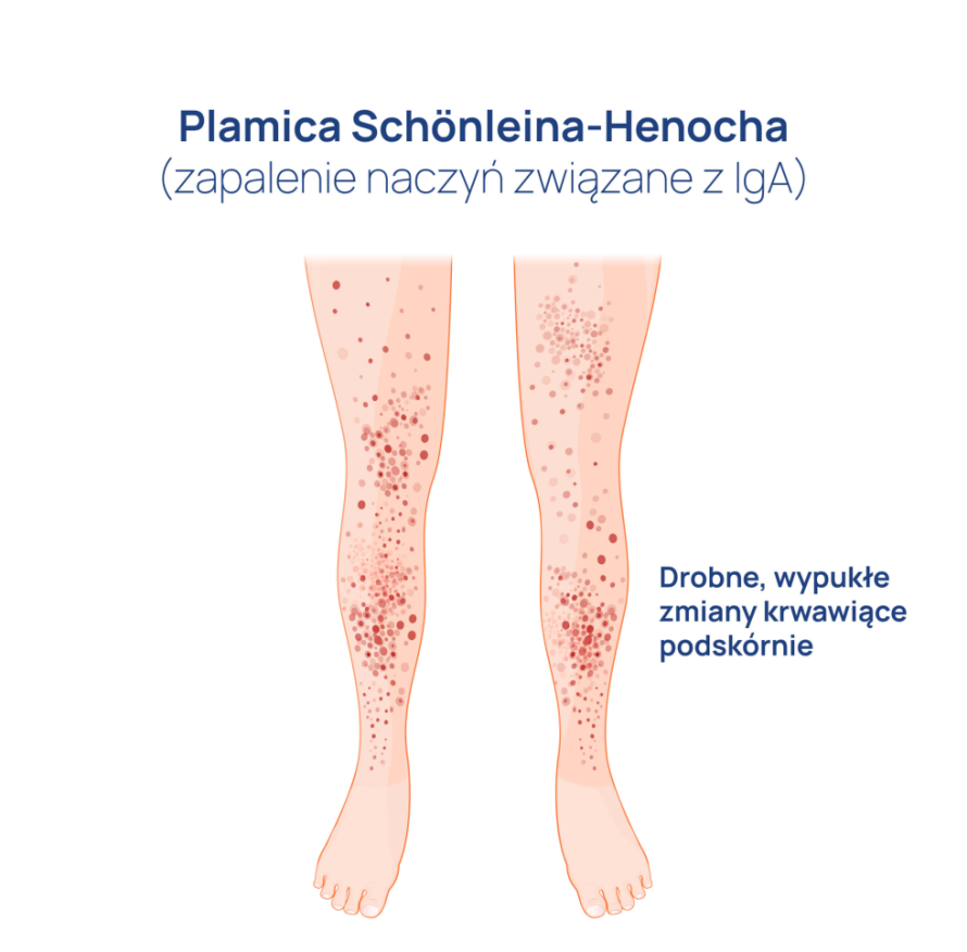 Plamica_Schonleina-Henochai_infografika