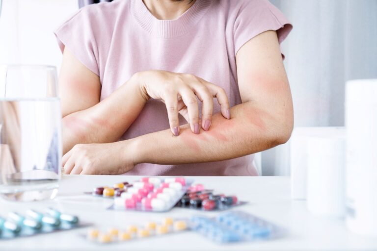 Uczulenie na antybiotyki – jakie są jego objawy i jak zdiagnozować alergię?
