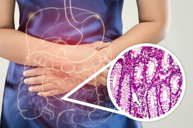 Czerwonka (dyzenteria) – co to za choroba? Objawy i leczenie 