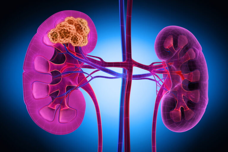Guz Wilmsa (nephroblastoma) – objawy, przyczyny i leczenie