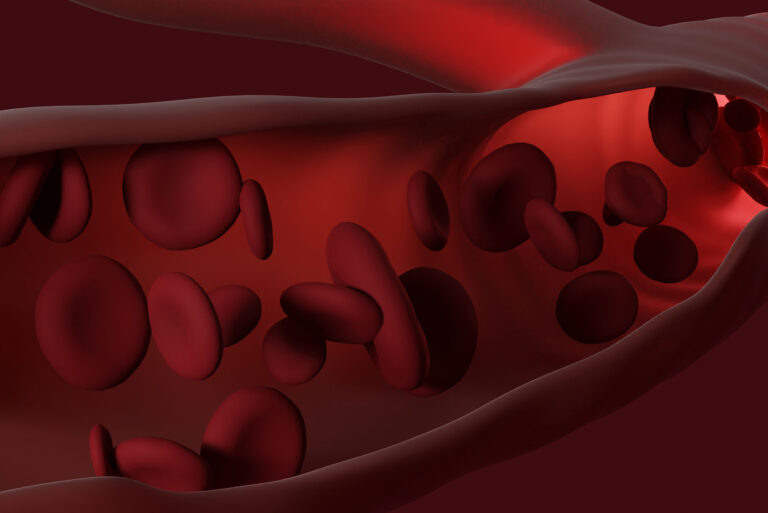 Nocna napadowa hemoglobinuria (PNH) – co to za choroba i jakie daje objawy?