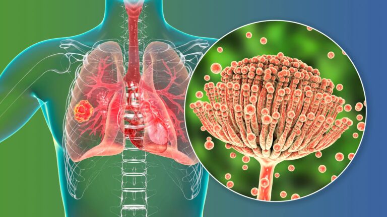 Aspergiloza – na czym polega i jakie daje objawy? Diagnostyka i leczenie       