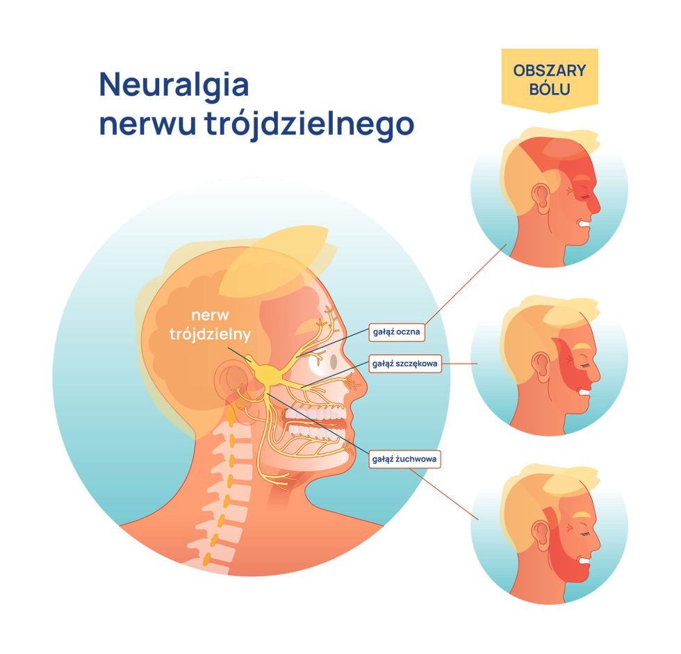 infografika neuralgia nerwu trójdzielnego