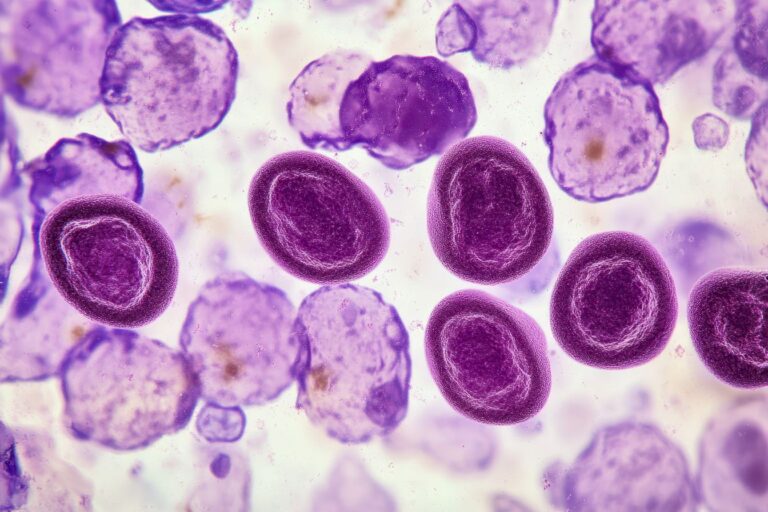 Niedokrwistość (anemia) normocytarna – na czym polega? Przyczyny, objawy i leczenie