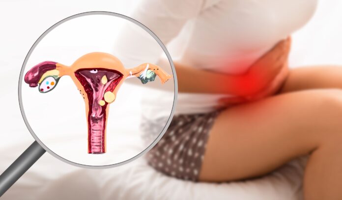 nietypowe objawy endometriozy