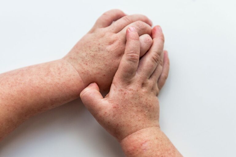 Szkarlatyna (płonica) u dzieci i dorosłych: objawy, przyczyny, diagnostyka i leczenie