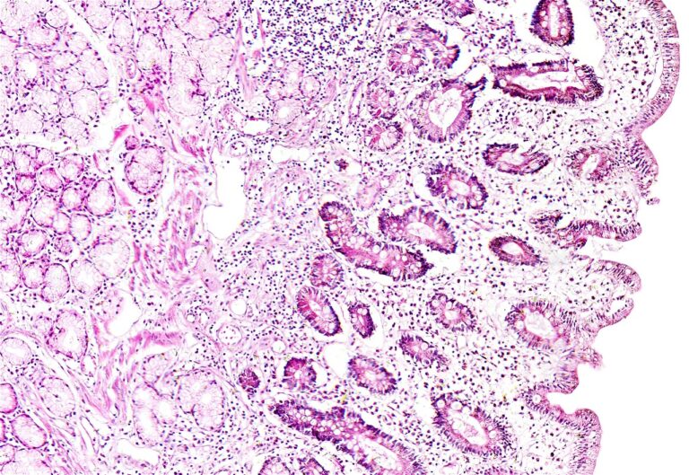 Metaplazja jelitowa – co to za schodzenie i jakie daje objawy? Diagnostyka i leczenie