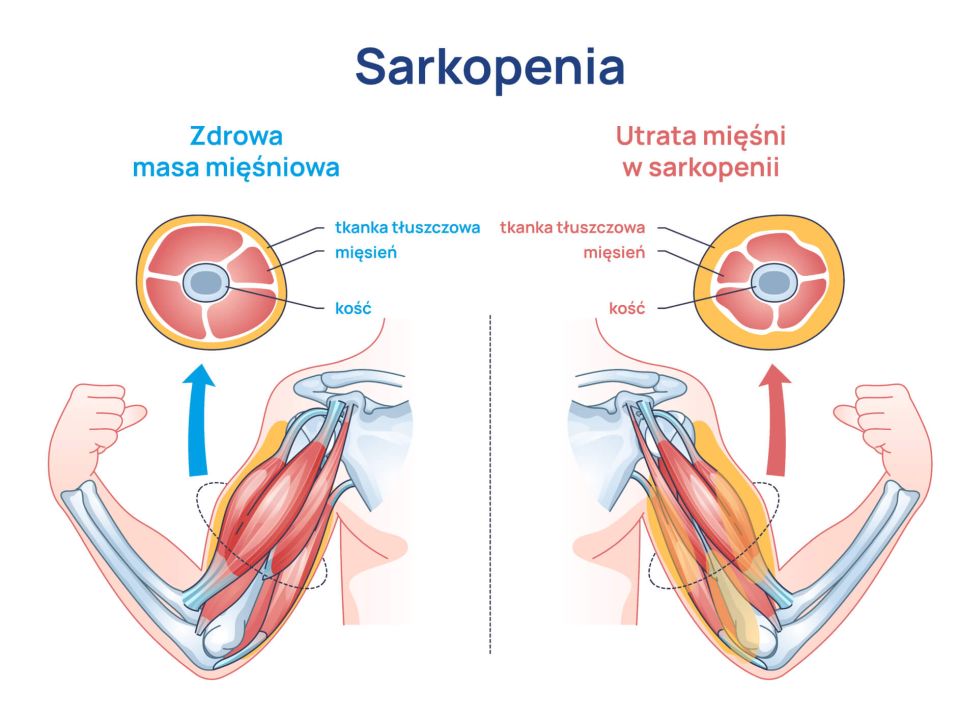 sarkopenia_infografika