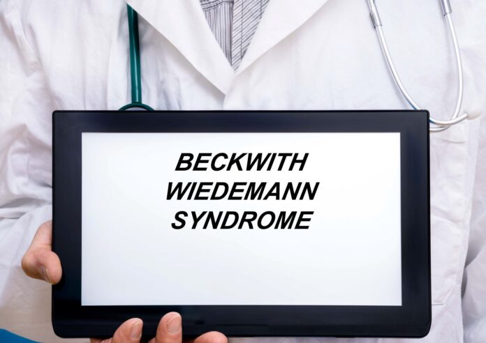 zespół Beckwitha-Wiedemanna