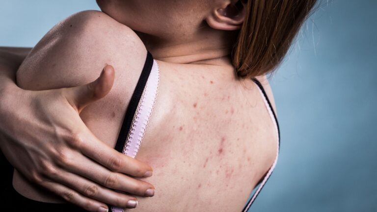 Trądzik grzybiczy – jak go rozpoznać? Objawy, przyczyny i leczenie