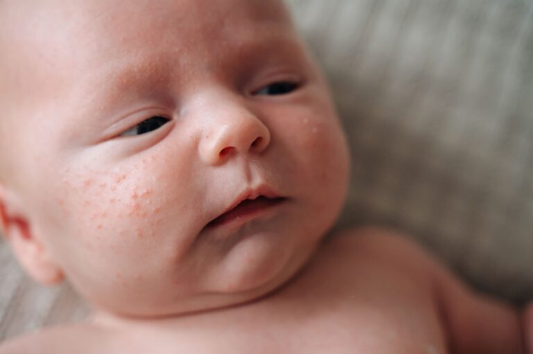 Trądzik niemowlęcy i noworodkowy – co go powoduje i ile trwa? Rozpoznanie i leczenie
