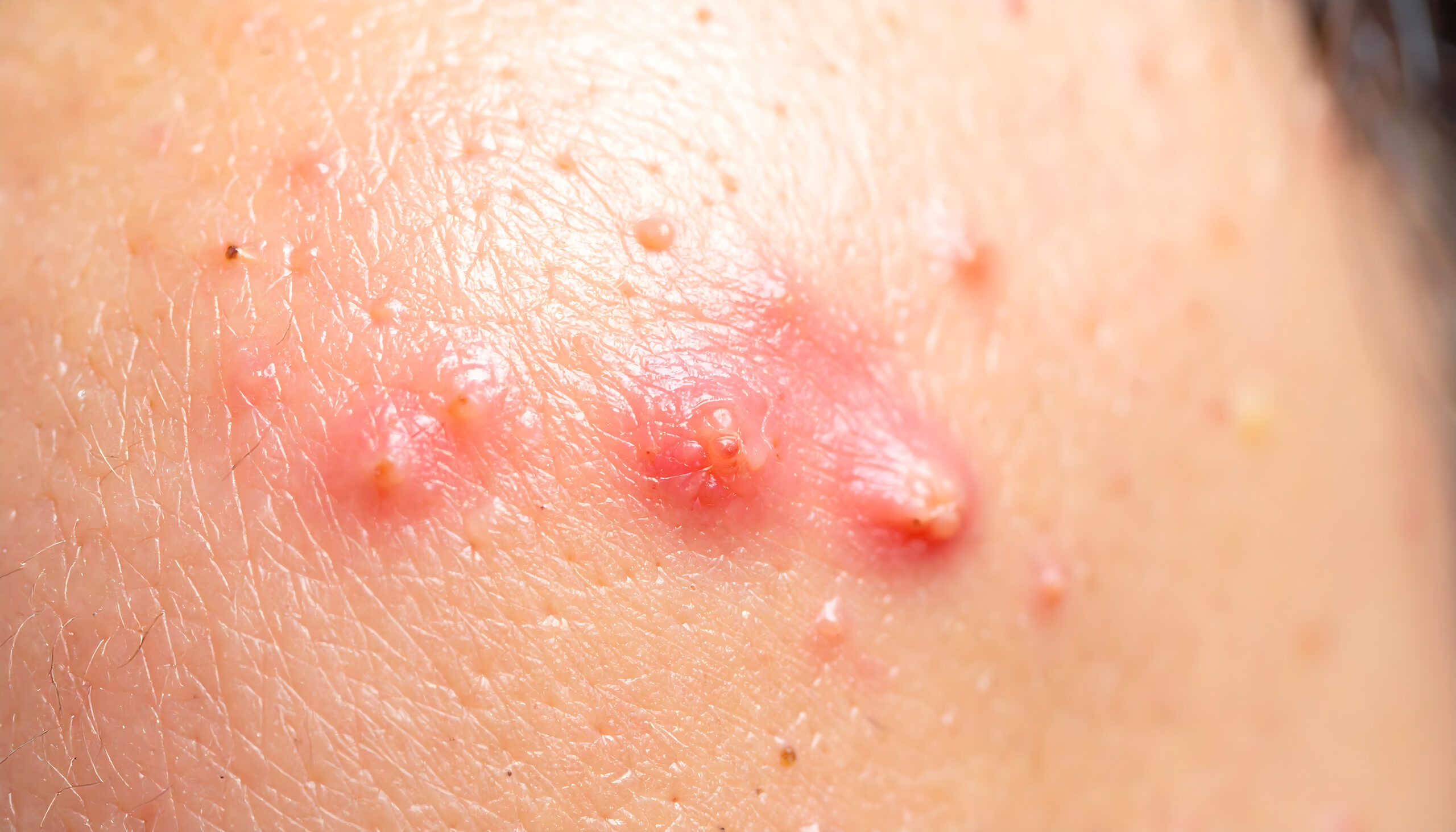 jak wygląda zapalenie mieszków włosowych