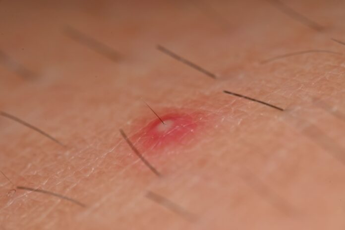 zapalenie_mieszków_włosowych zapalenie mieszków włosowych