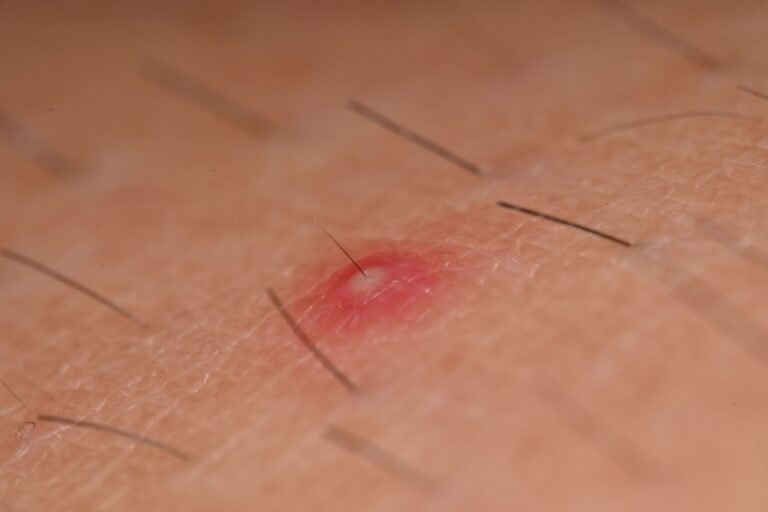 Zapalenie mieszków włosowych: przyczyny, objawy i leczenie