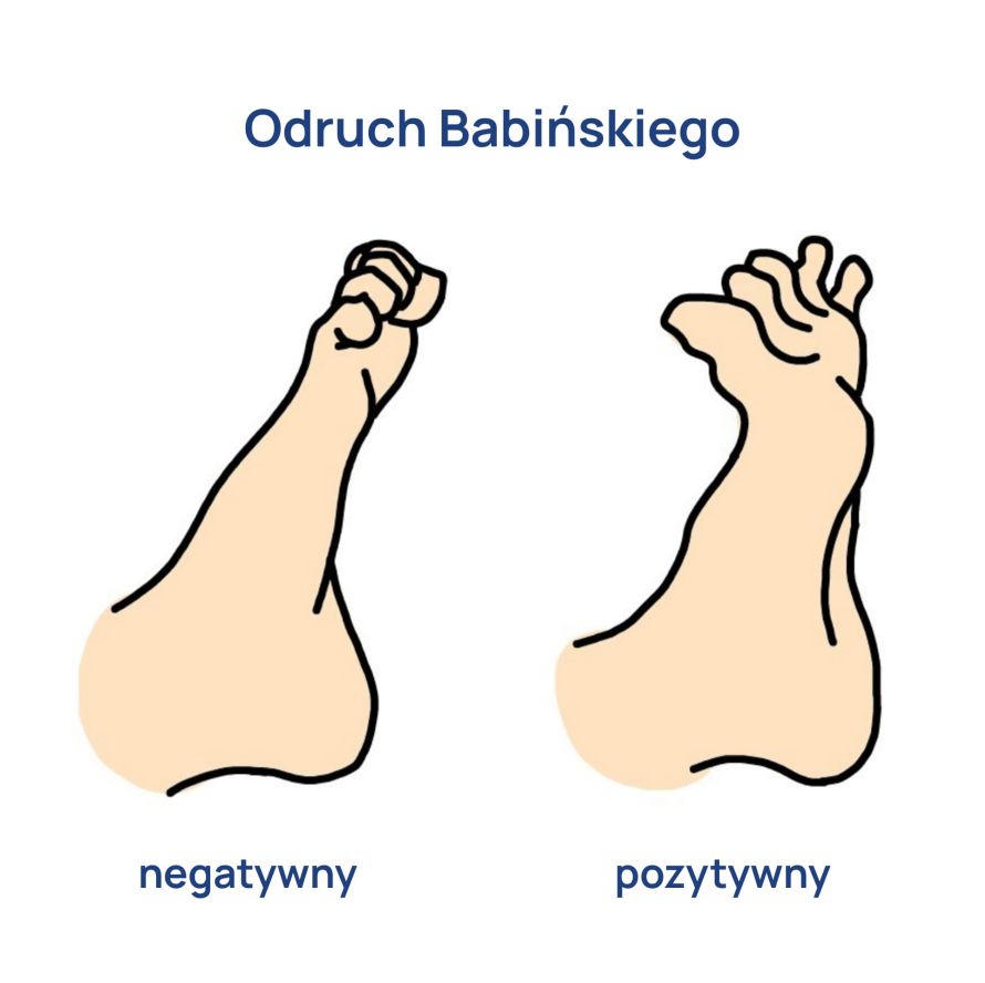 Objaw_Babinskiego_infografika