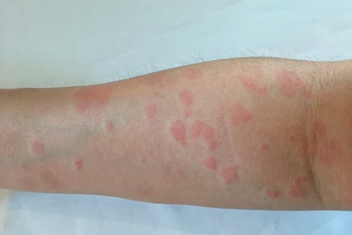 toczeń krążkowy cover