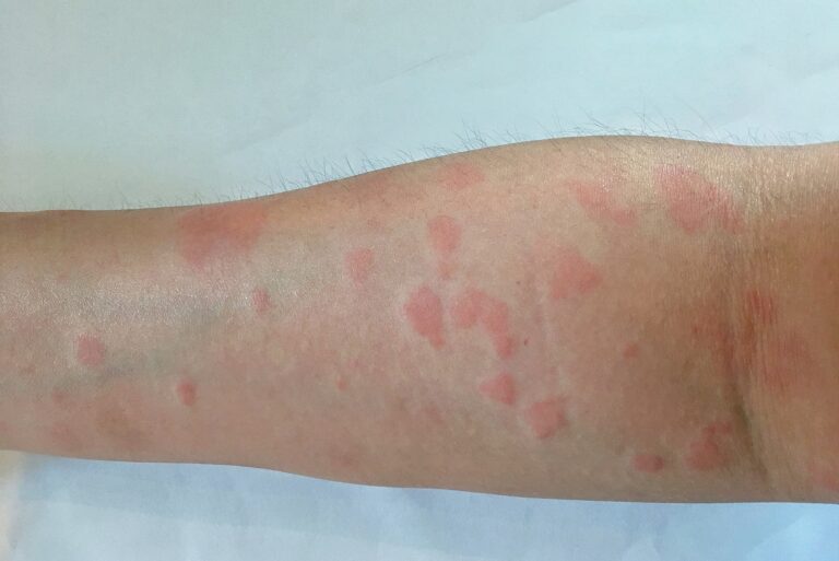 Toczeń rumieniowaty krążkowy – czym jest i jakie są objawy?