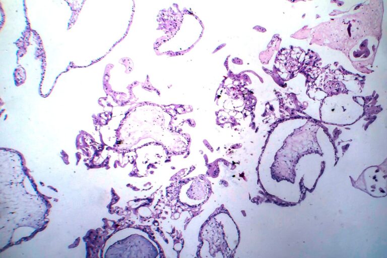 Zaśniad groniasty – czym jest i jak się objawia? Przyczyny, rozpoznanie i postępowanie