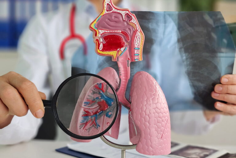 POCHP (przewlekła obturacyjna choroba płuc) – objawy, przyczyny, diagnostyka i leczenie